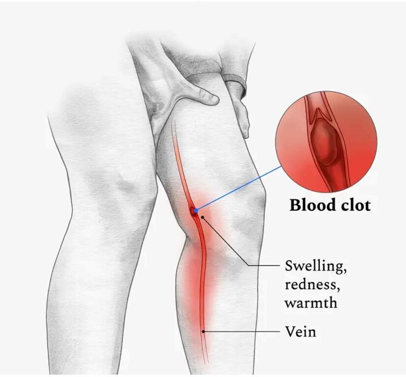 DEEP VEIN THROMBOSIS(DVT) - varicose veins treatment