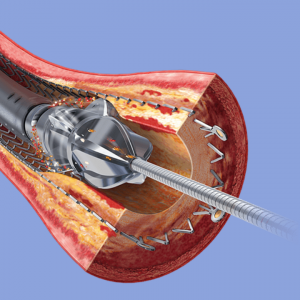 Atherectomy procedure for arterial disease