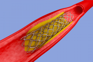 Stent angiogram treatment for artery disease