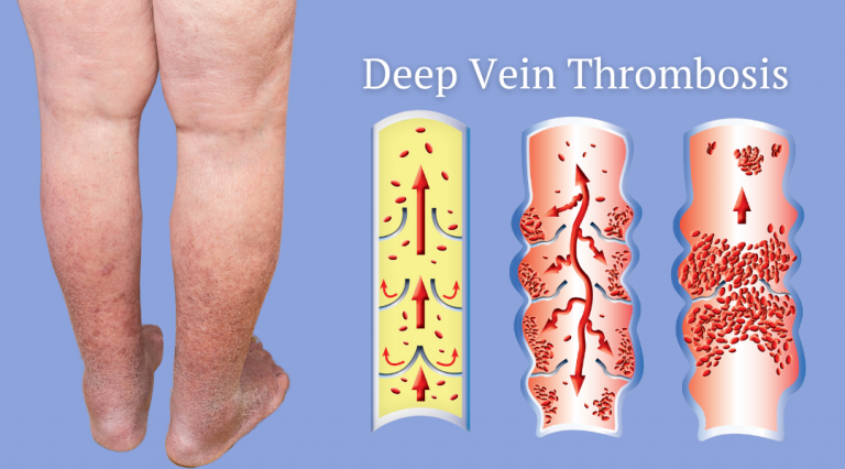 Deep Vein Thrombosis (DVT) Treatments - Monterey Bay Vascular