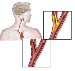 carotid artery disease or carotid artery stenosis diagram.