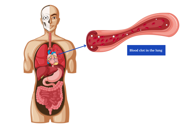 Deep Vein Thrombosis - Monterey Bay - Aptos & Salinas CA