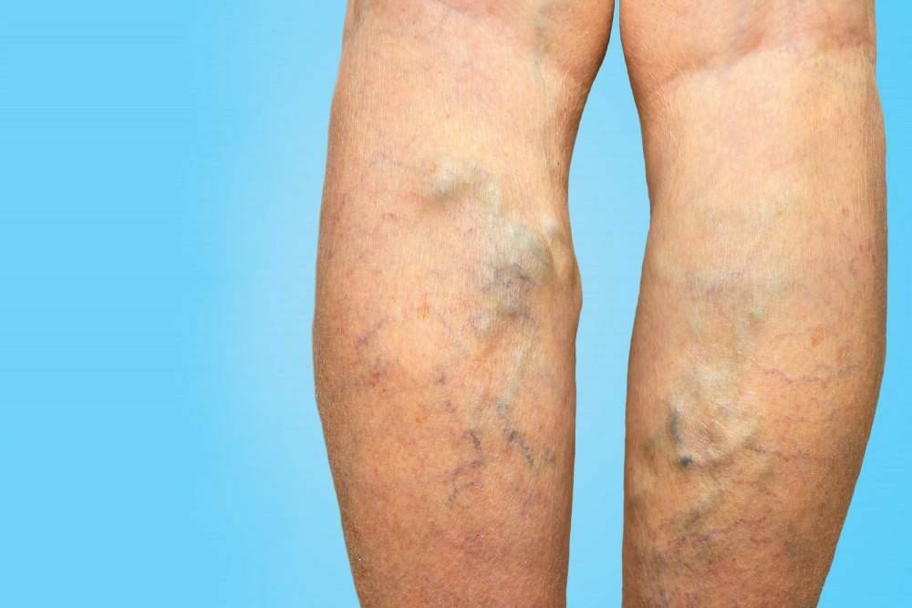 Chronic Venous Insufficiency (CVI) - Monterey Bay - Aptos & Salinas CA