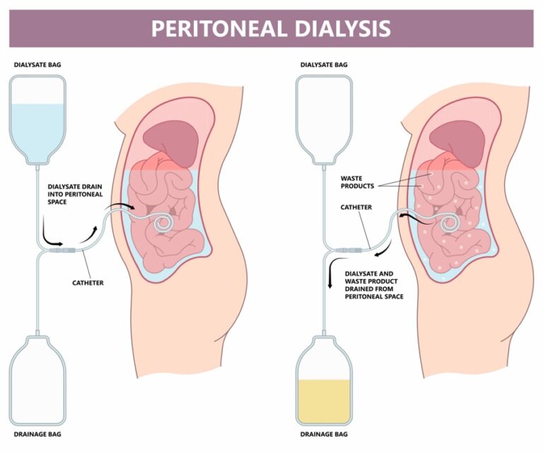 Pelvic Venous Disease - Monterey Bay - Aptos & Salinas CA