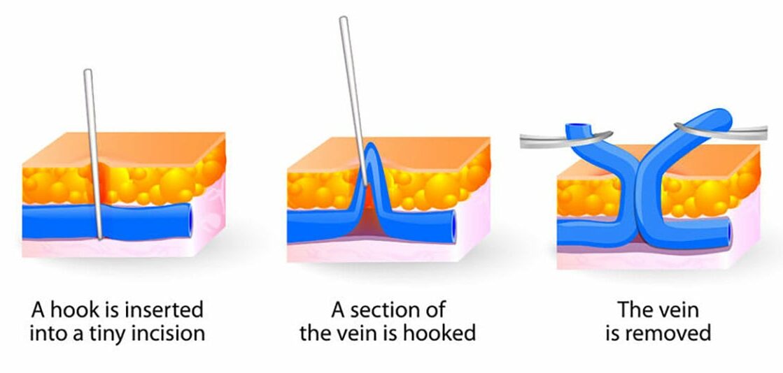 Deep Vein Thrombosis (DVT) Treatments - Monterey Bay Vascular