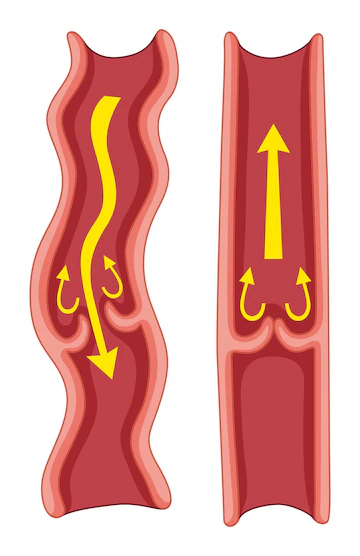 Deep Vein Thrombosis - Monterey Bay - Aptos & Salinas CA