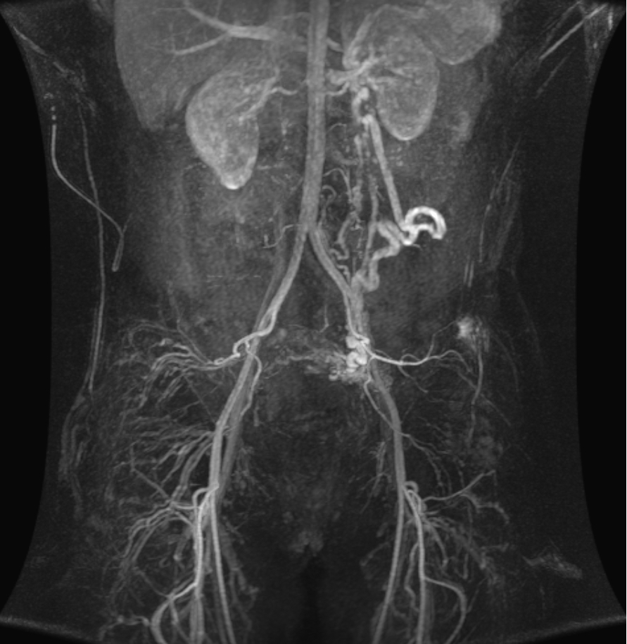 PELVIC CONGESTION SYNDROME