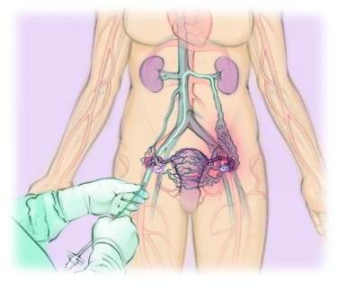 Pelvic Venous Congestion (PVCS) Treatment - Monterey Bay - Aptos & Salinas  CA