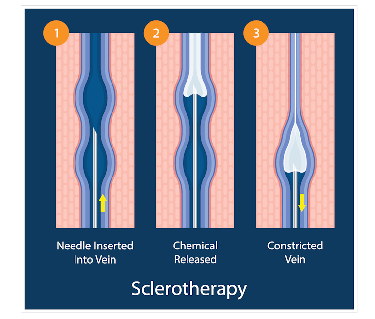 Deep Vein Thrombosis - Monterey Bay - Aptos & Salinas CA