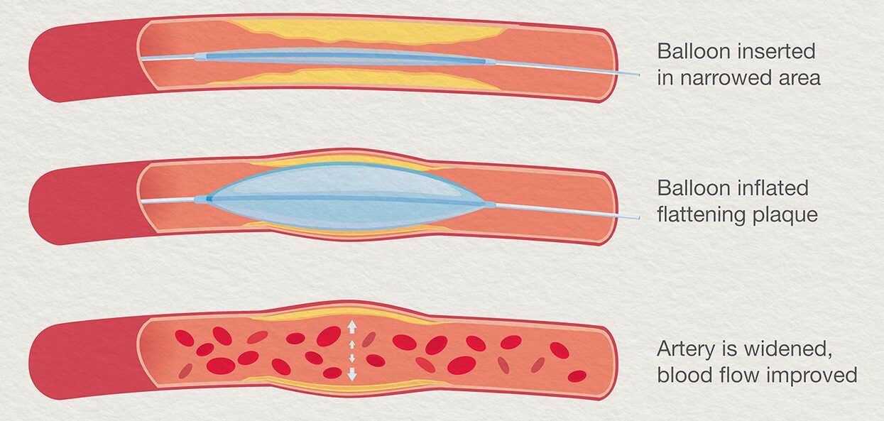 Arterial Disease Treatment - Monterey Bay - Aptos & Salinas CA