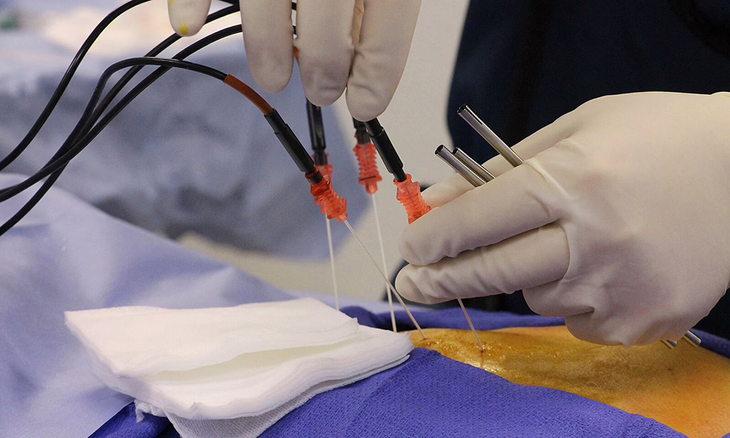 Radiofrequency Ablation Procedure For Chronic Pain