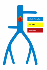Illustration showing an IVF filter within the inferior vena cava
