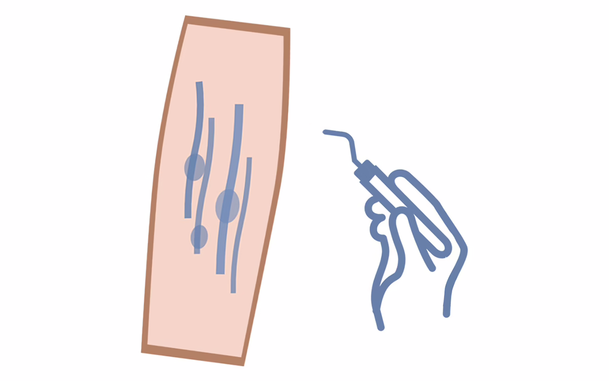 Illustration depicting a surgical hand holding a phlebotomy hook, beside a leg with swollen veins