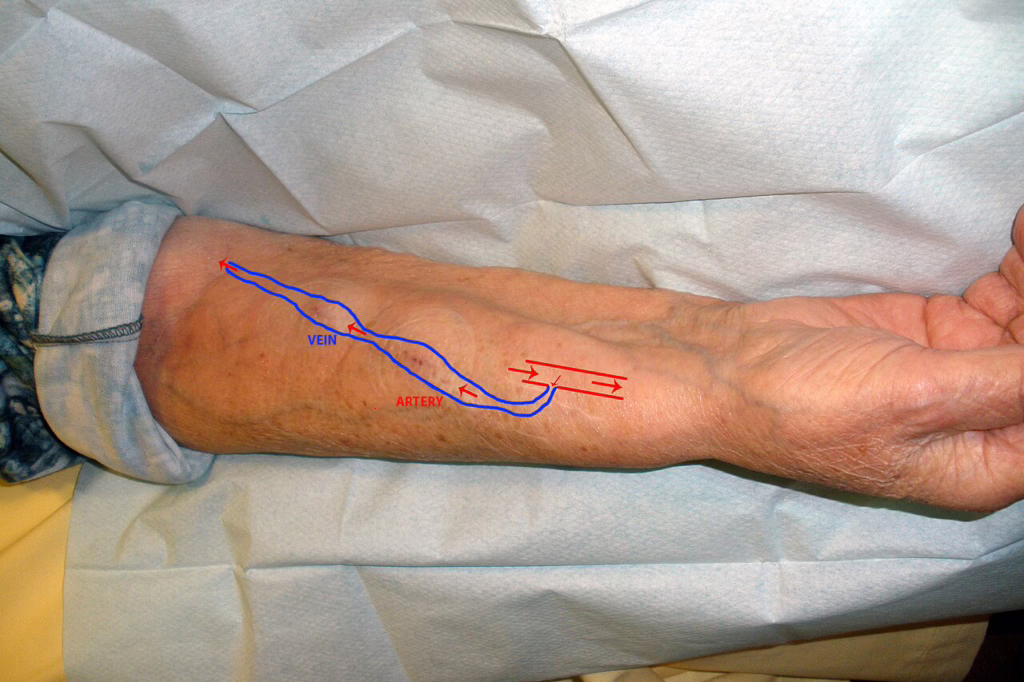 Schema of an arteriovenous fistula