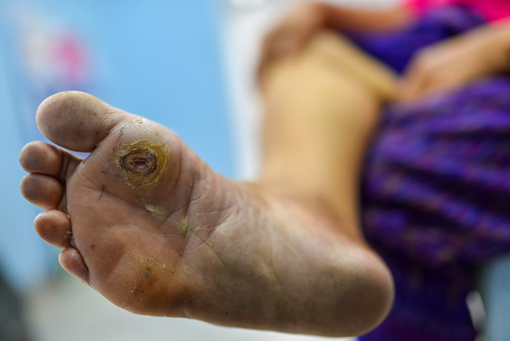A diabetic ulcer on the sole of a patient's foot